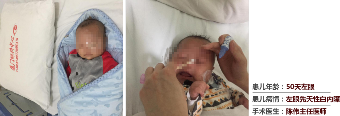 患兒年齡：50天左眼，患兒病情：左眼先天性白內(nèi)障，手術(shù)醫(yī)生：白內(nèi)障科陳偉主任醫(yī)師