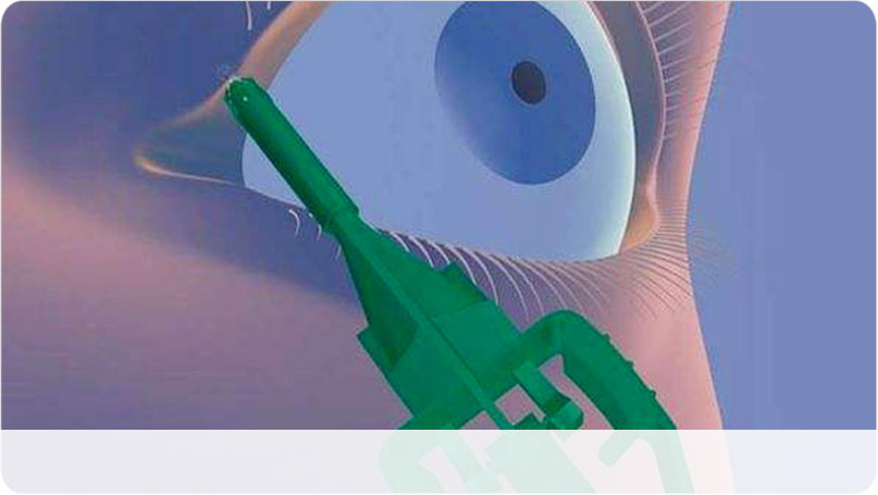 淚小點栓塞術(shù)