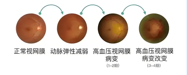 視網(wǎng)膜中央動脈阻塞