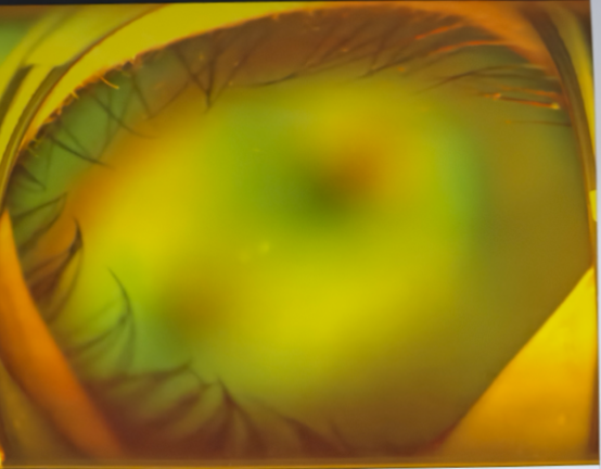 視網(wǎng)膜脫離